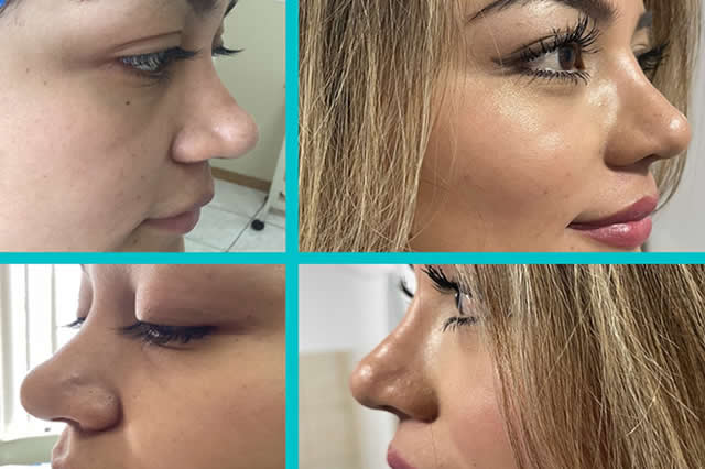 RESULTADOS RINOPLSTIA QUITO